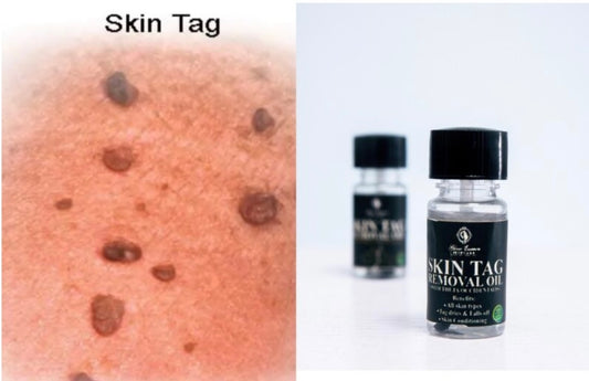 Skin tag oil remover